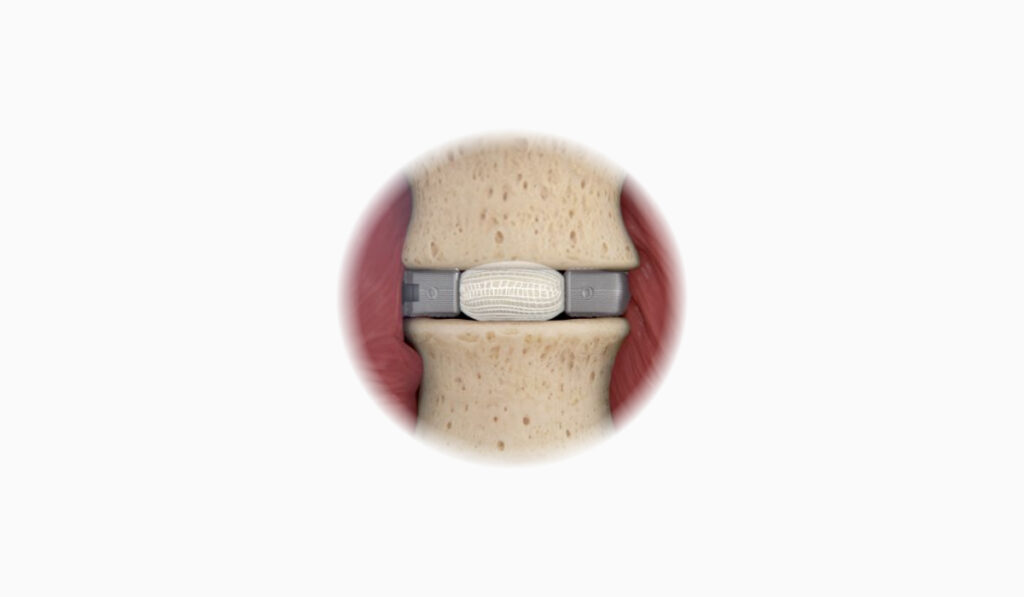 Spineology Completes Enrollment in Post-Market Study of Novel, Expandable Lateral Implant