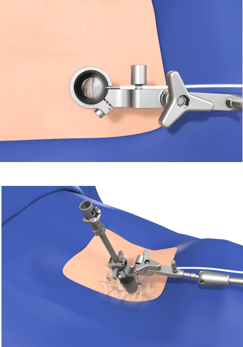 SOAR™ RETRACTOR SYSTEM