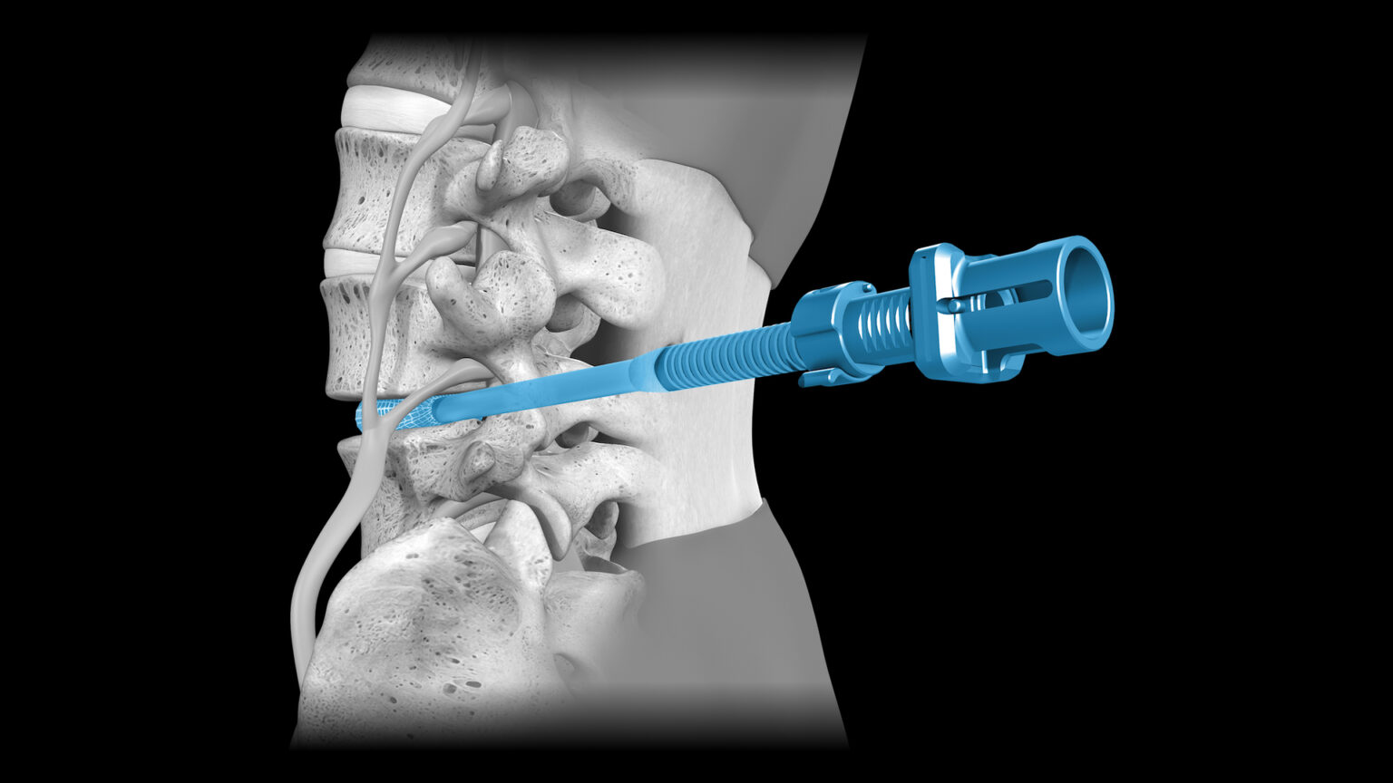 Optilif OptiLIF - Spineology