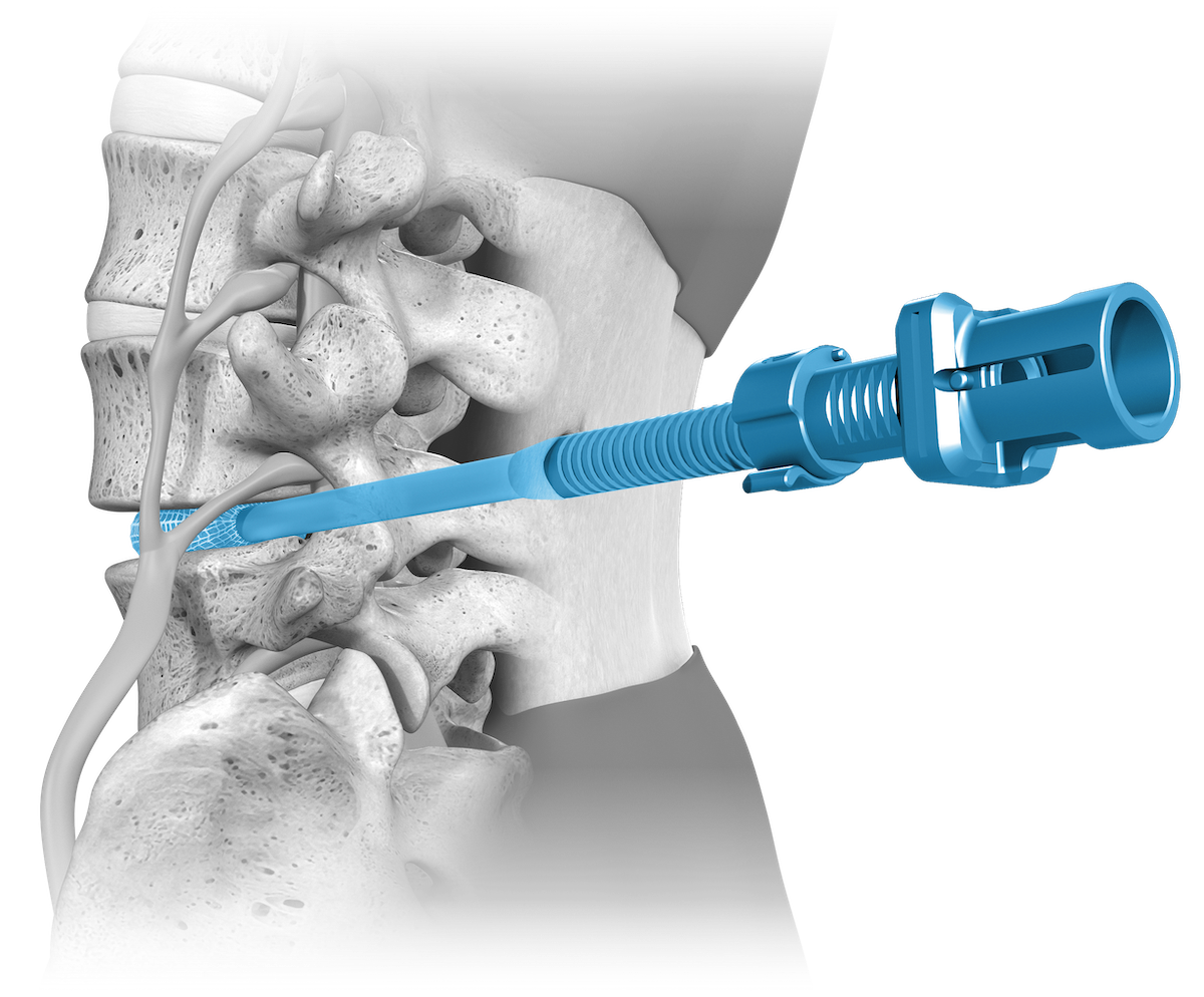 OptiMesh OptiLIF Procedure