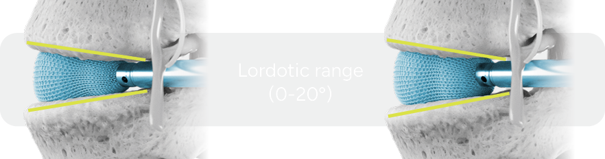 OptiMesh Align lordotic range web OptiMesh Align lordotic range web